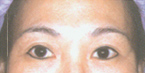 肉毒桿菌:修飾眉型除皺前