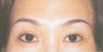 肉毒桿菌:修飾眉型除皺後